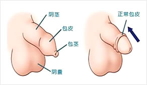 光离子包皮精细整形术